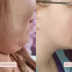 Przed i po zabiegu lipolizy podbródka. Zobacz, jak zmienił się profil! Sprawdź lipoliza podbródka cena.