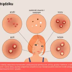 Ilustracja przedstawia różne rodzaje trądziku: grudki, guzki, zaskórniki, krosty i torbiele.