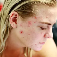 Dziewczyna z pryszczami na twarzy, szukająca skutecznego rozwiązania, jak tribiotic na pryszcze.