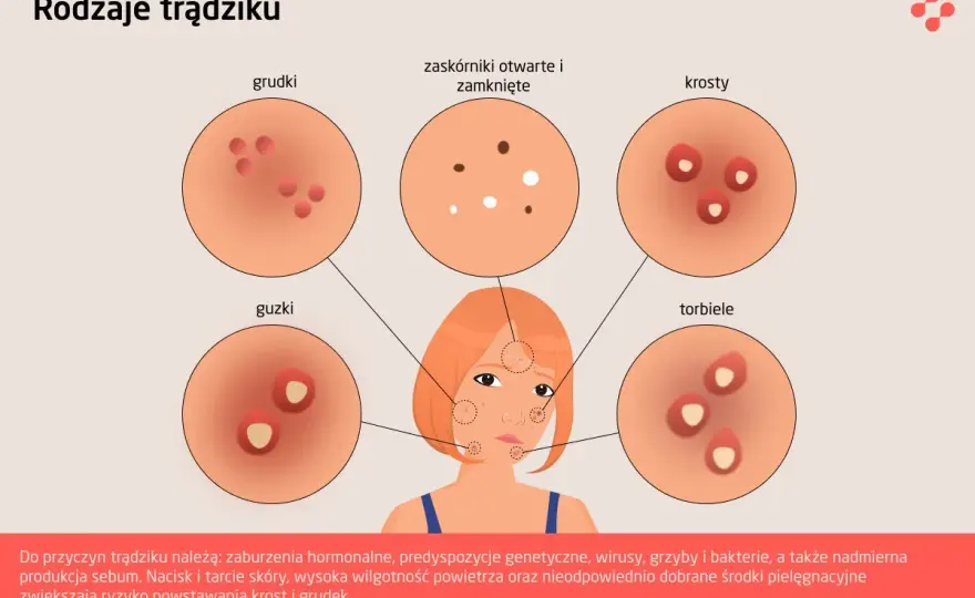 Rodzaje trądziku - Jak rozpoznać i skutecznie leczyć?