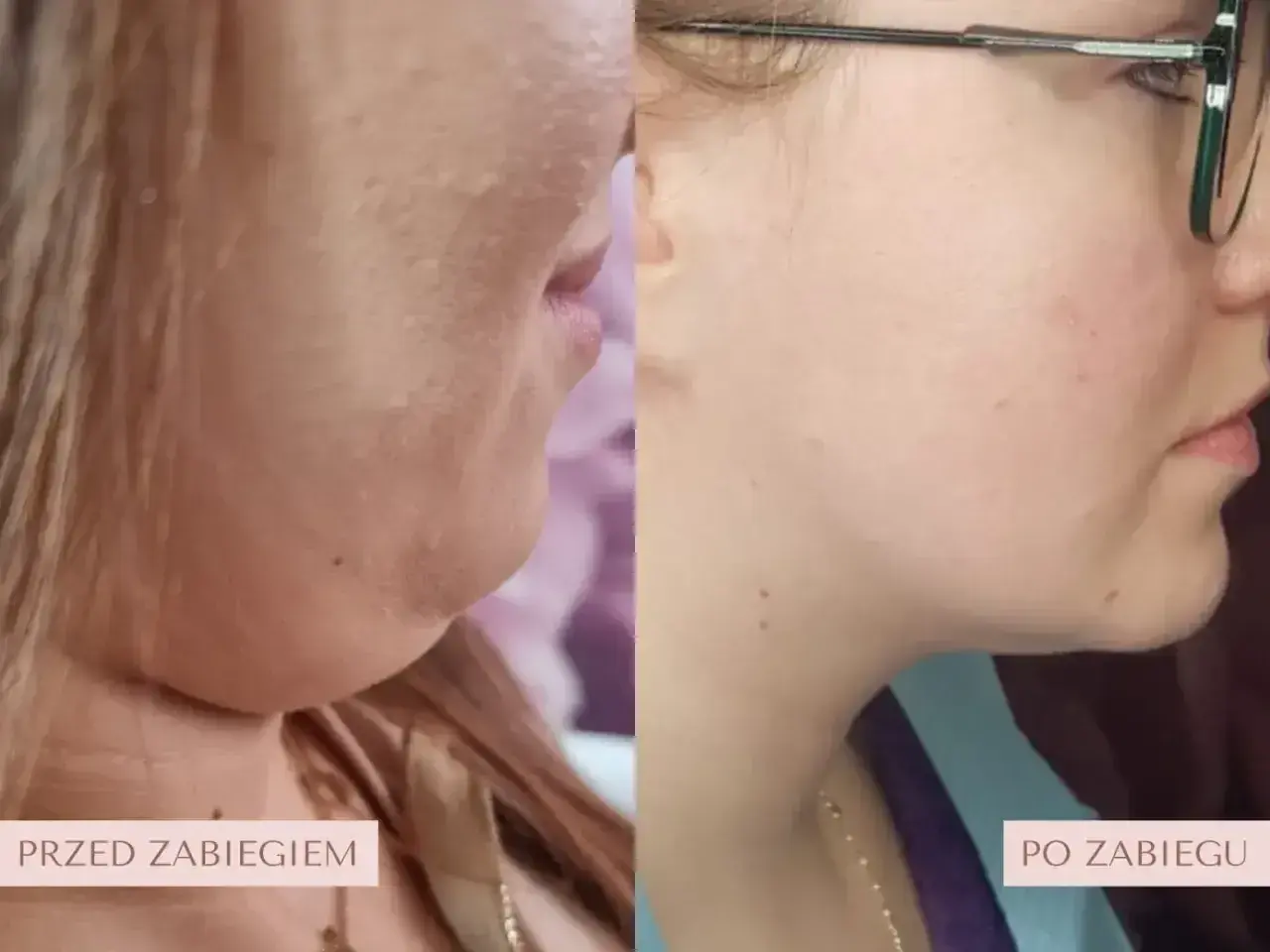 Przed i po zabiegu lipolizy podbródka. Zobacz, jak zmienił się profil! Sprawdź lipoliza podbródka cena.