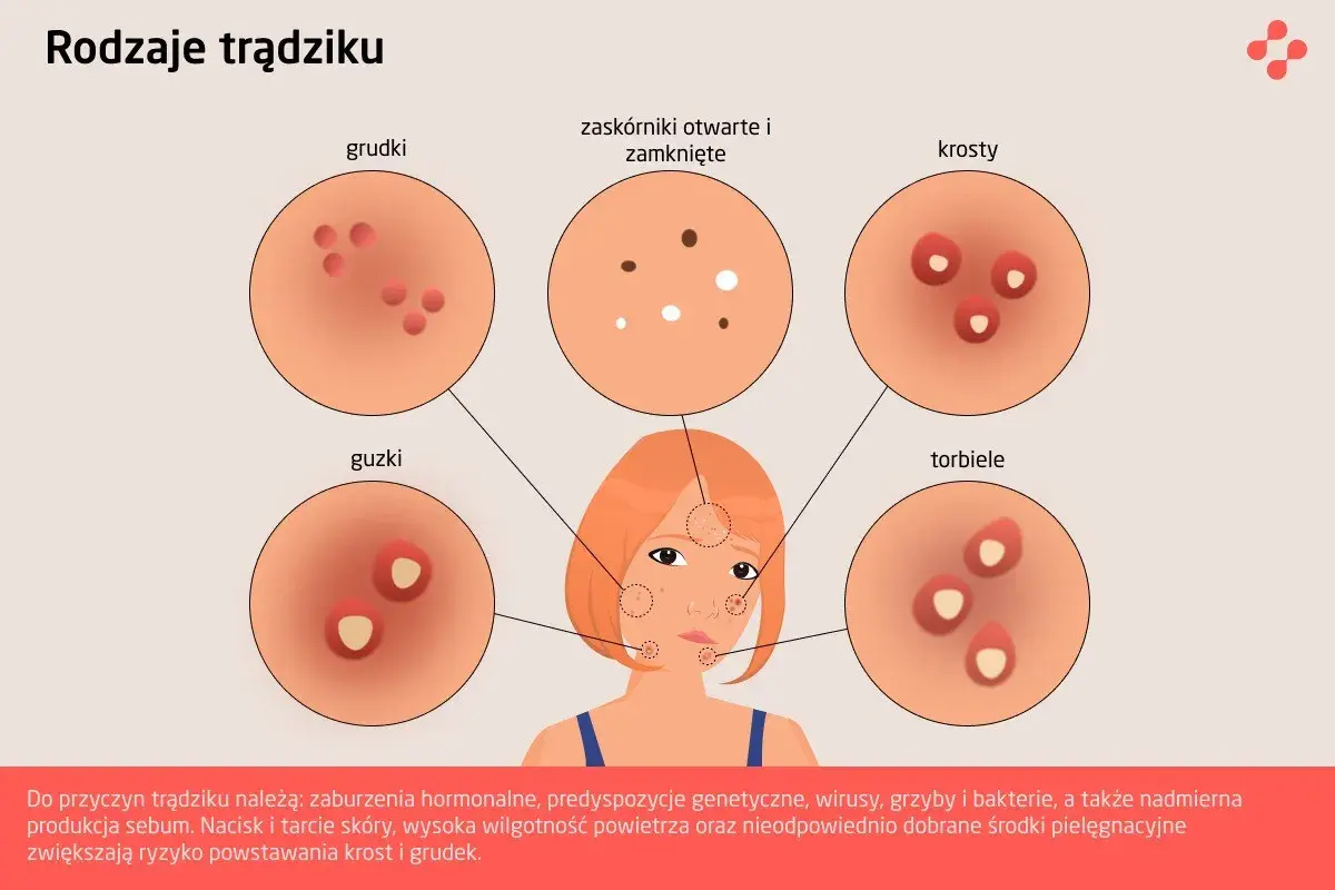 Ilustracja przedstawia różne rodzaje trądziku: grudki, guzki, zaskórniki, krosty i torbiele.