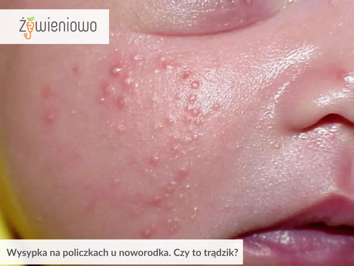 Skóra niemowlaka z widocznym trądzikiem niemowlęcym na policzku. Małe, czerwone krostki i grudki.