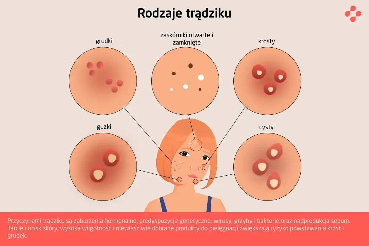 Ilustracja przedstawia różne rodzaje trądziku: grudki, zaskórniki, krosty, guzki i cysty.